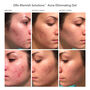 Dr Dennis Gross DRx Blemish Solutions™ Acne Eliminating Gel, 1 oz., , large image number 2