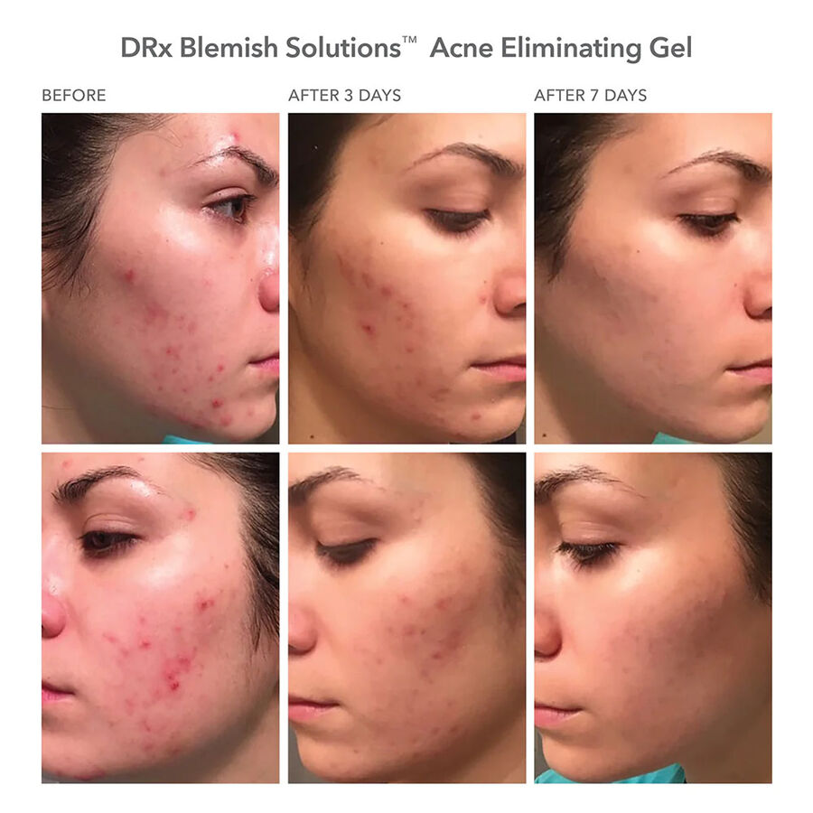 Dr Dennis Gross DRx Blemish Solutions™ Acne Eliminating Gel, 1 oz., , large image number 2