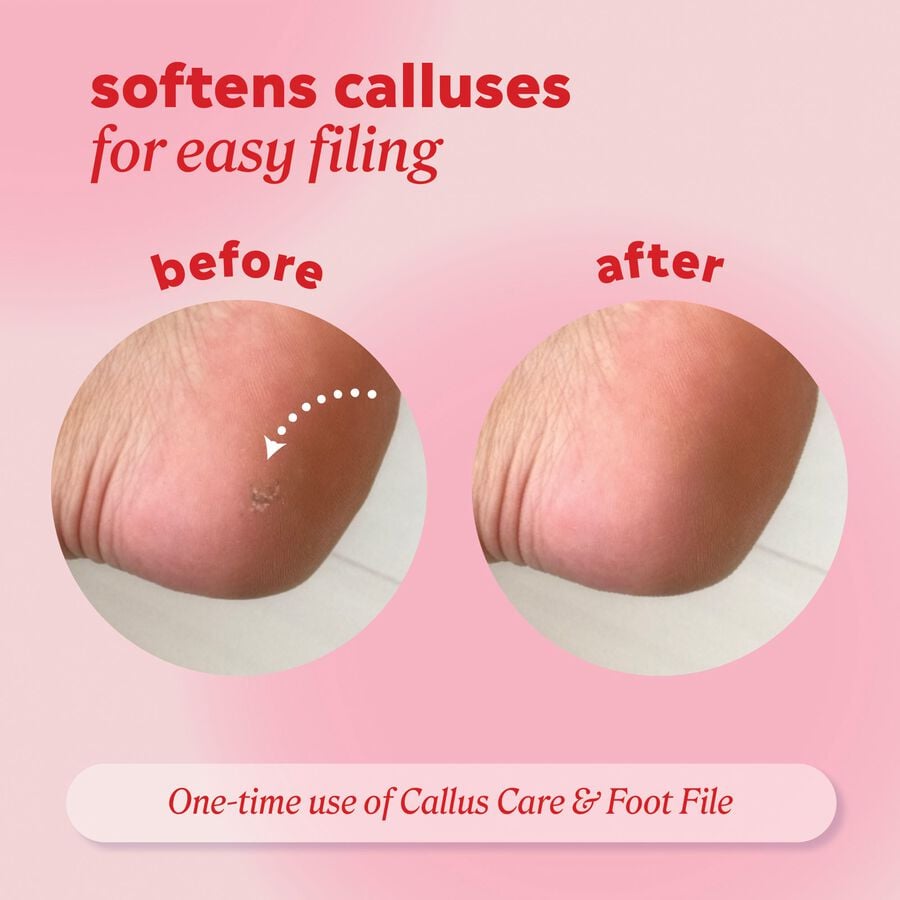 ONYX Professional Callus Care Callus & Corn Peeling Gel, , large image number 5