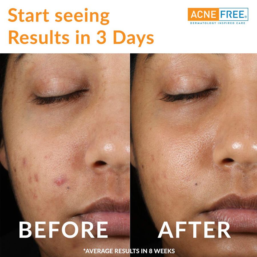 AcneFree Oil Free 24 HR Acne Clearing System, 3 Piece Kit, , large image number 3